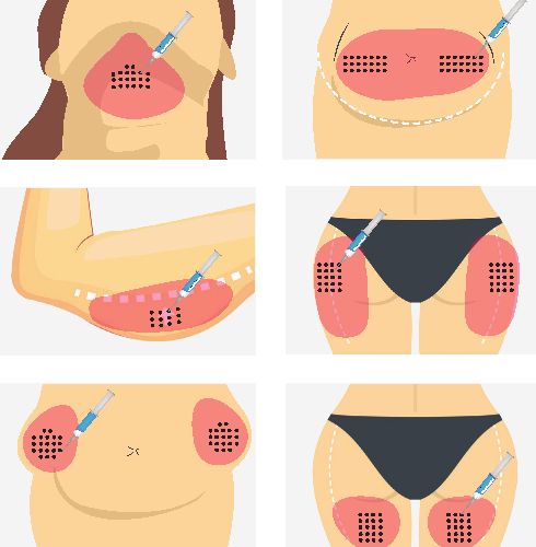 Likwidacja miejscowych depozyt&oacute;w tłuszczu